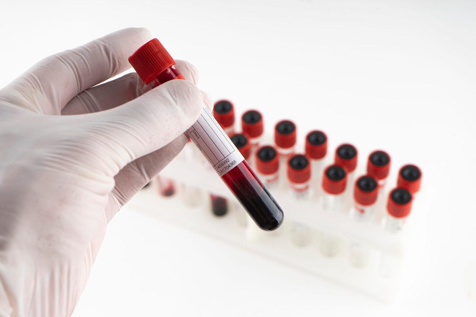 deficiência de vitamina b12 sintomas e tratamentos
