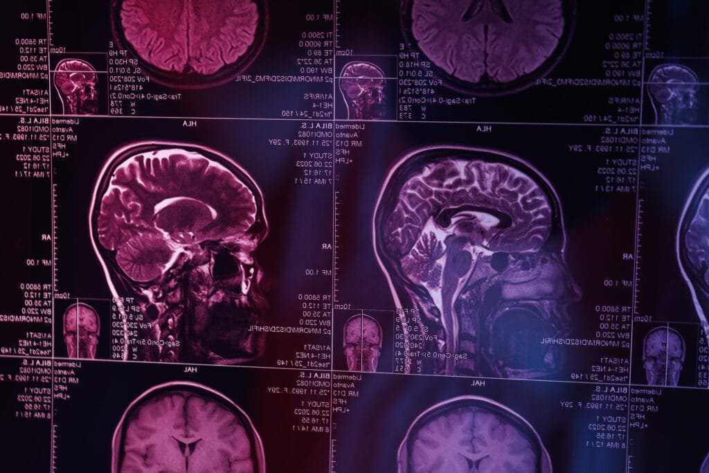 neuroinflamação sintomas