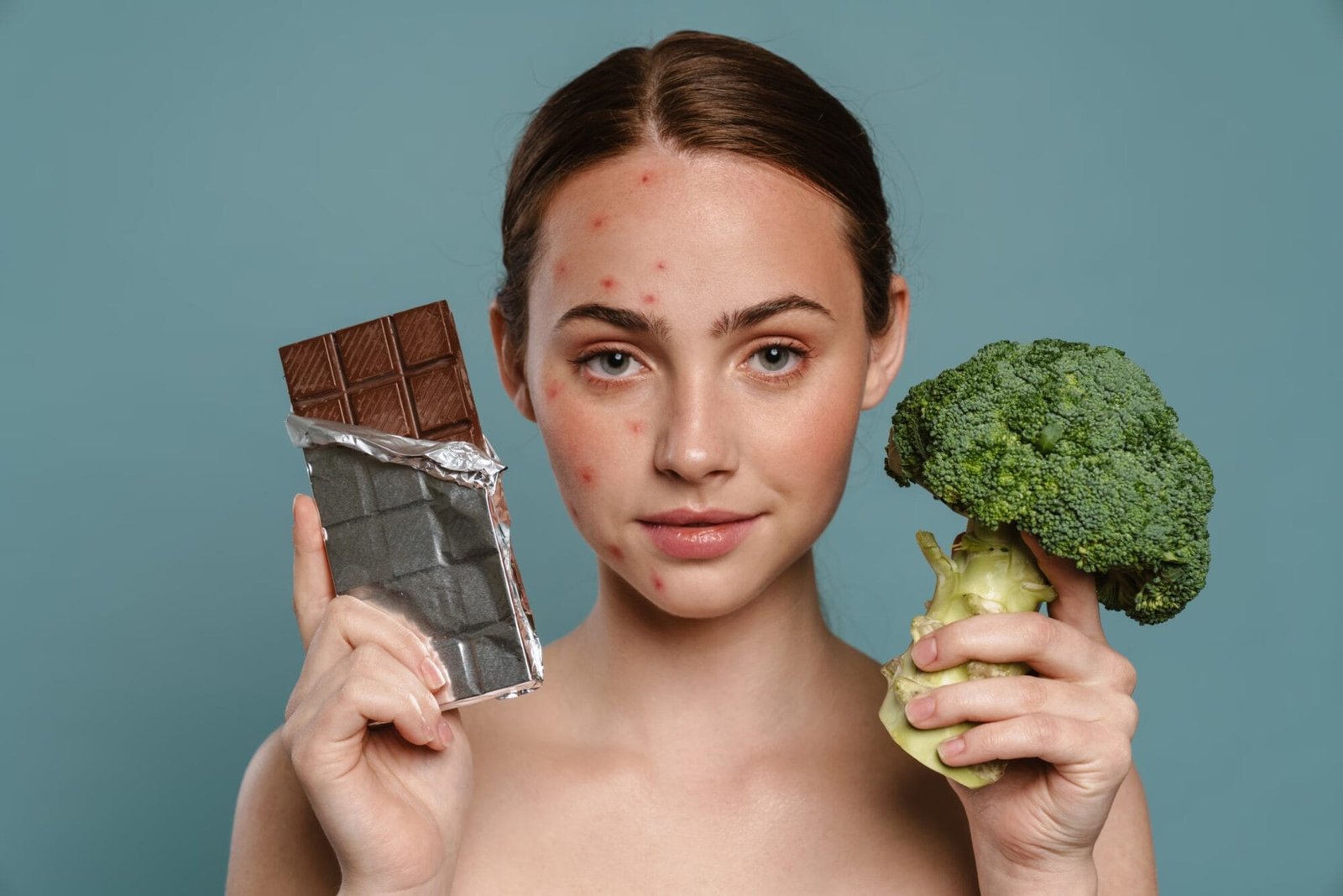 Alimentos que causam acne