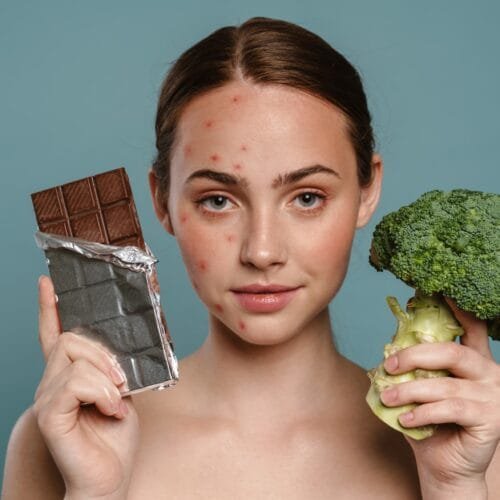 Alimentos que causam acne